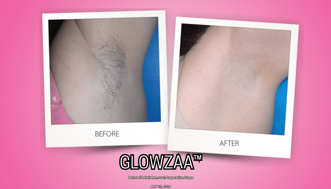 IPL Hair Removal Before and After